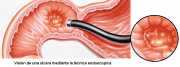 La endoscopia.png